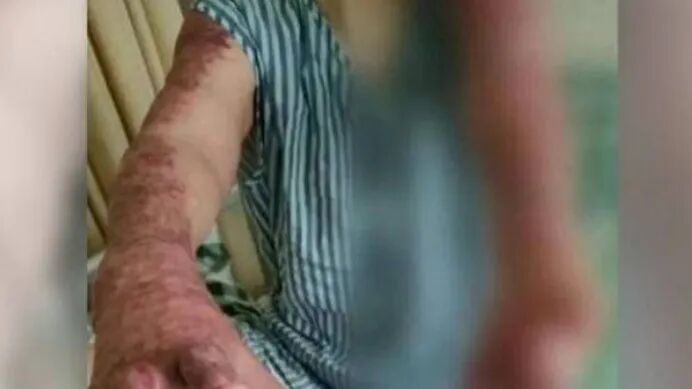 Dongguan Woman Gets ¥634K After Phone Fire in Bed