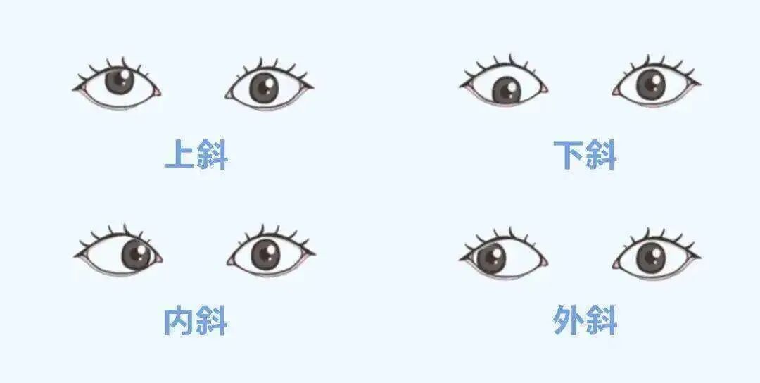 新技术不再斜眼看世界我院斜视矫正术助你重拾自信