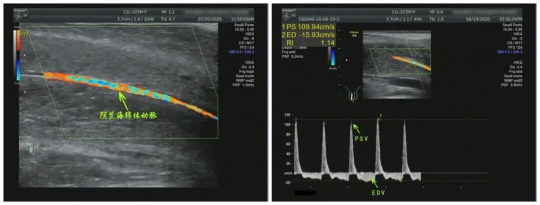 阴茎多普勒检查什么房事勃起变差，做个阴茎血流检查！_https://www.jmylbn.com_新闻资讯_第6张