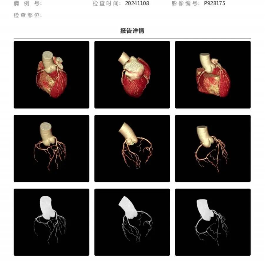 联影有哪些CT患者福音，再添利器！第903医院引进联影160排320层UCT天河860高端螺旋CT_https://www.jmylbn.com_新闻资讯_第6张