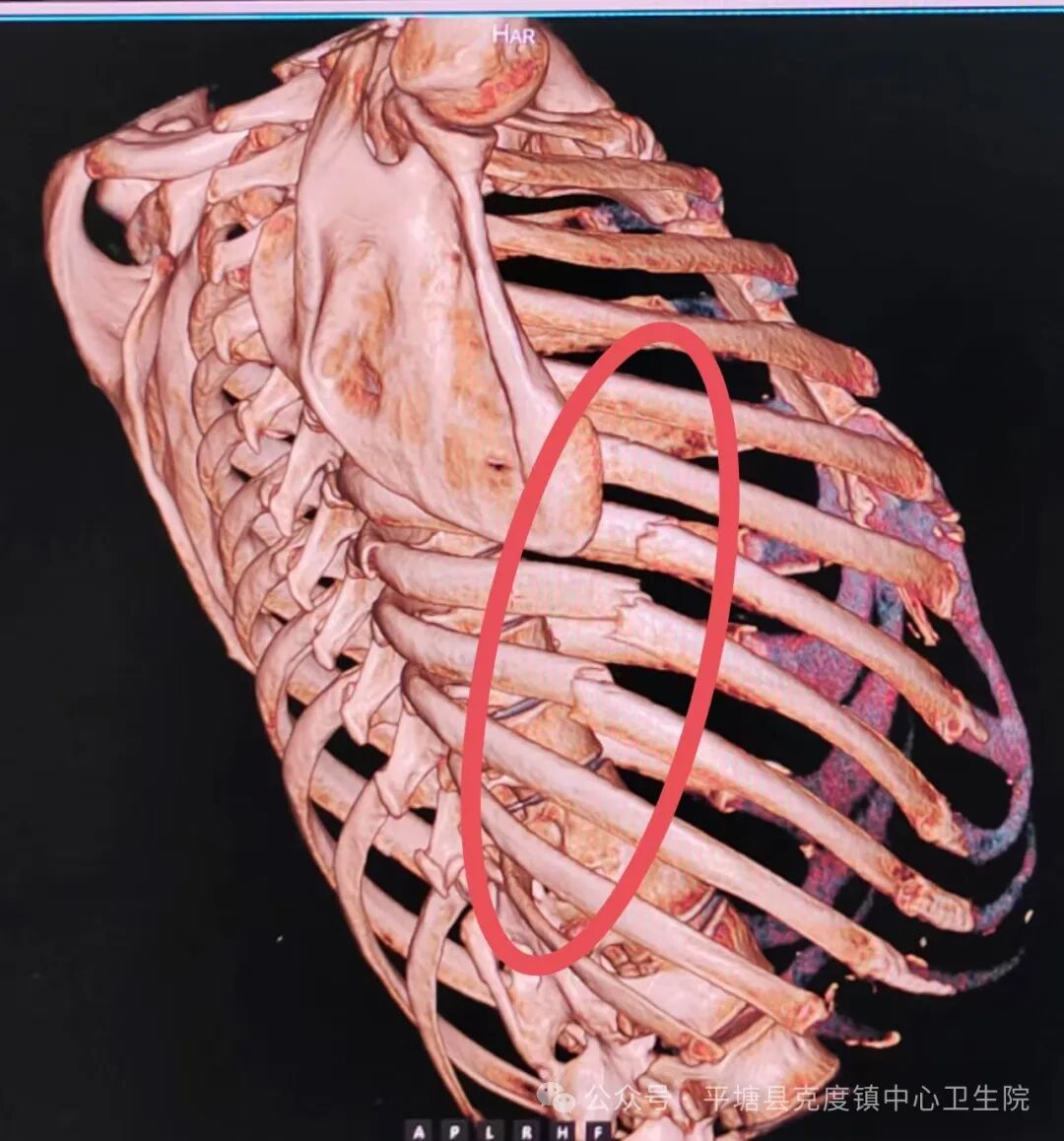 平塘县基层首例肋骨骨折切开复位内固定术在克度分院成功开展!