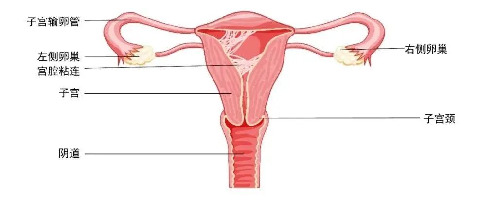备孕人群必看！宫腔粘连的5个信号