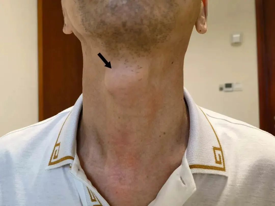 【医学科普】陶磊教授团队：甲状舌管囊肿和甲状腺有关系吗？