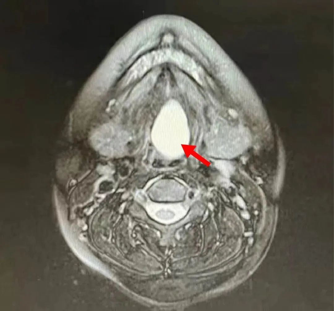 【医学科普】陶磊教授团队：甲状舌管囊肿和甲状腺有关系吗？