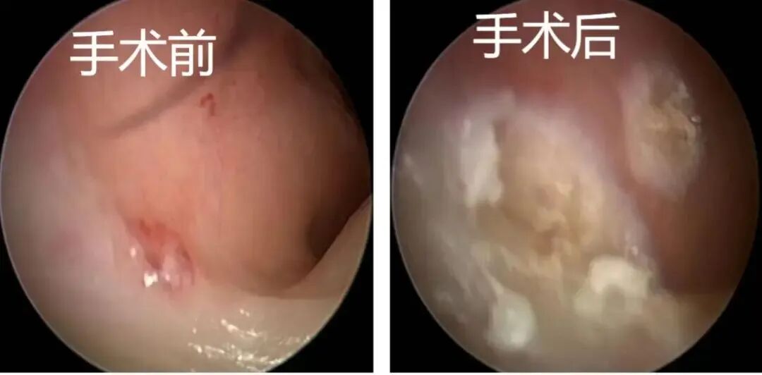 什么是电凝止血【关爱患者】鼻出血如何正确处理？电凝止血是什么？_https://www.jmylbn.com_新闻资讯_第10张