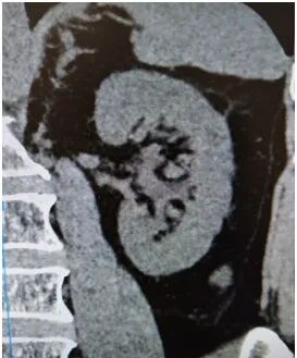 输尿管鞘是什么名医动态｜以柔克刚，无创取石——我院泌尿外科开展可弯曲负压吸引鞘+输尿管软镜钬激光碎石术_https://www.jmylbn.com_新闻资讯_第3张