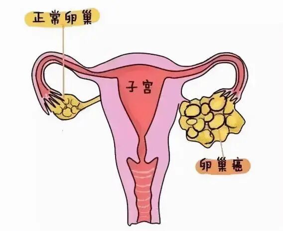 什么是结扎速血管闭合女子腹胀、腹痛以为是胃肠道不适，结果是卵巢癌！市二多学科合力诊治→_https://www.jmylbn.com_新闻资讯_第4张