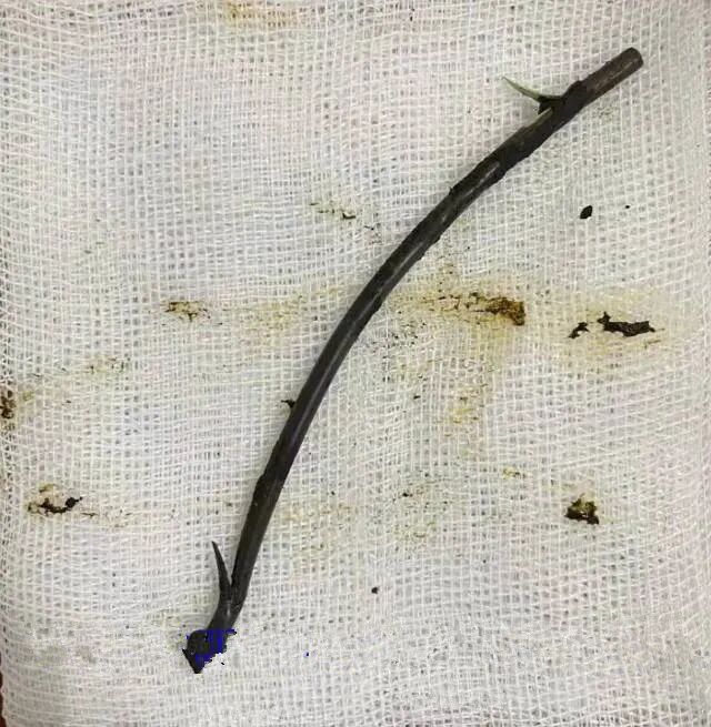 胆管支架什么样子【医学前沿】放置20年的胆道支架，你会怎么取？ 不开刀，“取支架”又“取石”！_https://www.jmylbn.com_新闻资讯_第5张