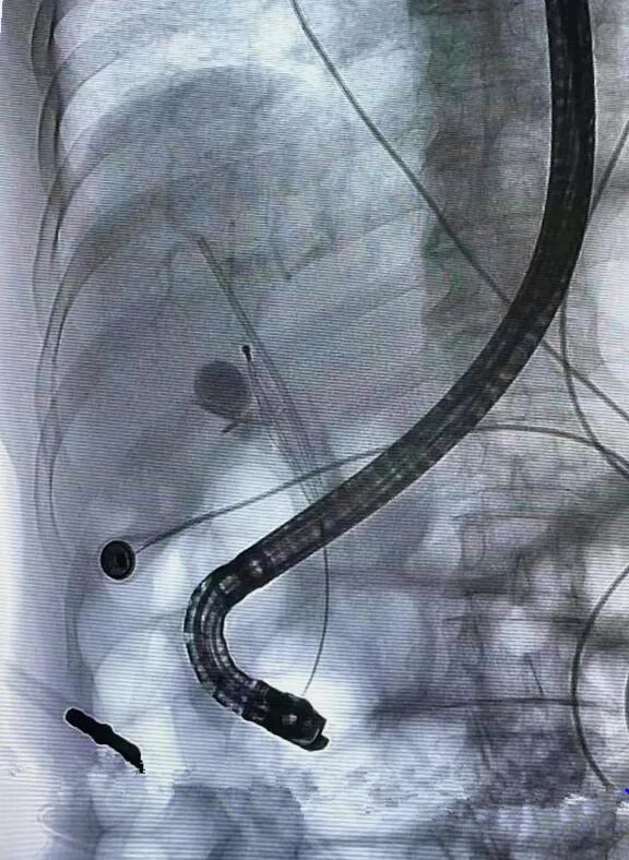 胆管支架什么样子【医学前沿】放置20年的胆道支架，你会怎么取？ 不开刀，“取支架”又“取石”！_https://www.jmylbn.com_新闻资讯_第4张