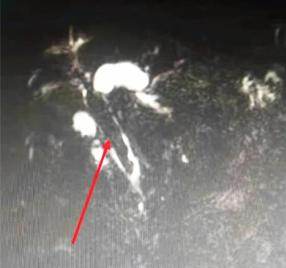 胆管支架什么样子【医学前沿】放置20年的胆道支架，你会怎么取？ 不开刀，“取支架”又“取石”！_https://www.jmylbn.com_新闻资讯_第3张