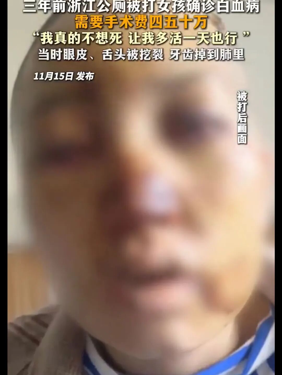 浙江公厕被打女孩确诊白血病,徐某浙江公厕被打女孩确诊白血病：警方调查施暴者俞某未..