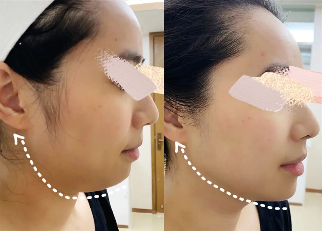 消除双下巴-拥有迷人下颌线双下巴成因(三)下颌骨发育不良,短小,后缩