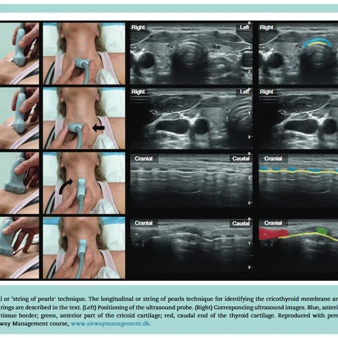 气管插管纱布怎么垫急诊仅0.4%？梅奥专家揭秘：清醒插管85%成功率的救命法则！(附详细图解)_https://www.jmylbn.com_新闻资讯_第18张
