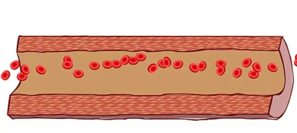 彩色经颅多普勒是什么【广医保定｜健康科普·功能检查科】带你认识经颅多普勒超声检查_https://www.jmylbn.com_新闻资讯_第5张