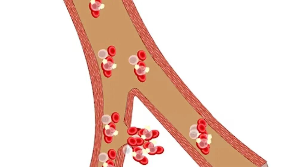 彩色经颅多普勒是什么【广医保定｜健康科普·功能检查科】带你认识经颅多普勒超声检查_https://www.jmylbn.com_新闻资讯_第6张