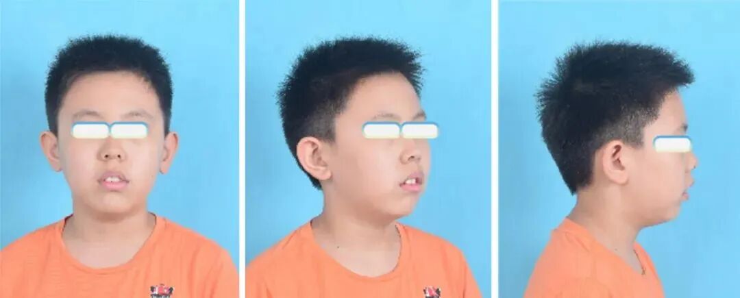 为什么戴呼吸机还是打鼾奥运冠军自曝「终身戴呼吸机」！这种病猝死率很高，孩子得了更危险_https://www.jmylbn.com_新闻资讯_第8张