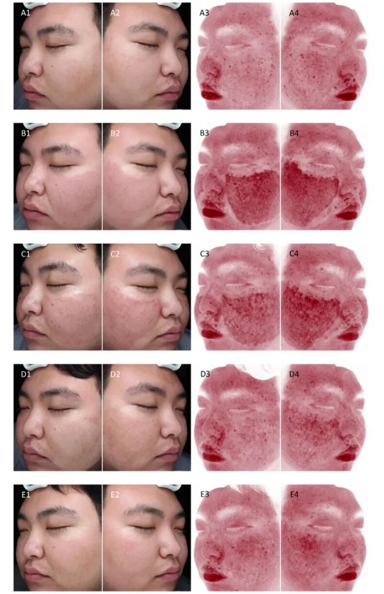 点阵激光后冷敷怎么敷红霉素眼膏 vs 冷敷贴：CO₂点阵激光治疗后伤口愈合比较_https://www.jmylbn.com_新闻资讯_第6张