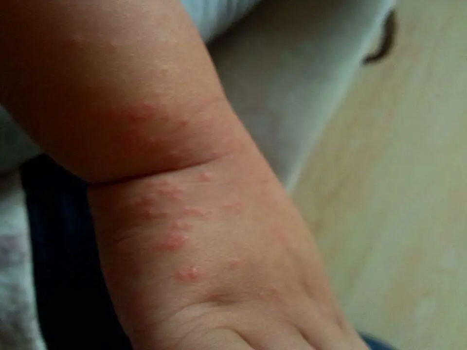 看著都疼！11個月女童手腕潰爛、險些截肢，只因這東西…… 親子 第5張