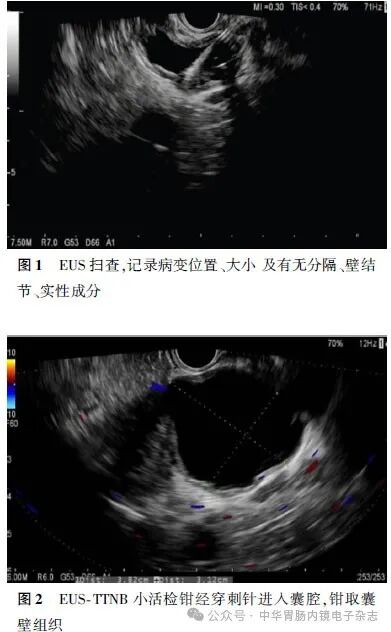 活检钳怎么用超声内镜引导下经穿刺针活检钳活检在胰腺囊性肿瘤诊断中的应用_https://www.jmylbn.com_新闻资讯_第2张