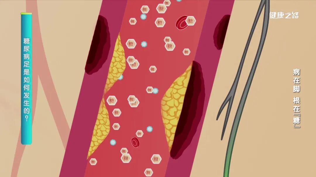 为什么糖尿病不能震动血糖高了，脚会遭殃？关注双脚，远离糖尿病足｜健康之路_https://www.jmylbn.com_新闻资讯_第4张