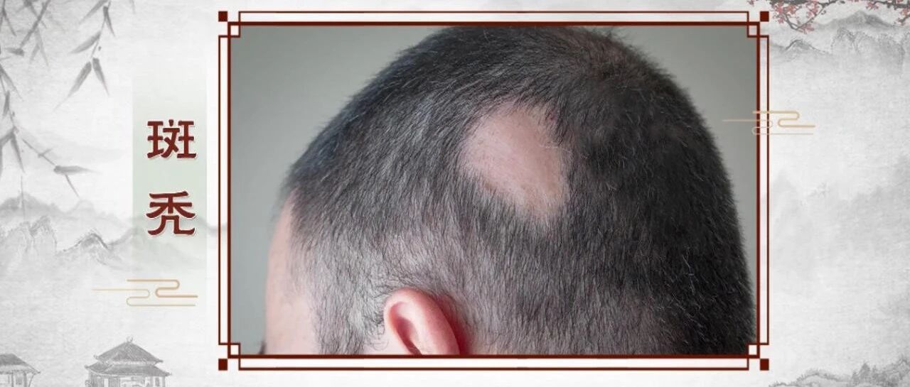 斑秃、脱发、头发油有救吗？有！快收好这份防脱发宝典！丨健康之路