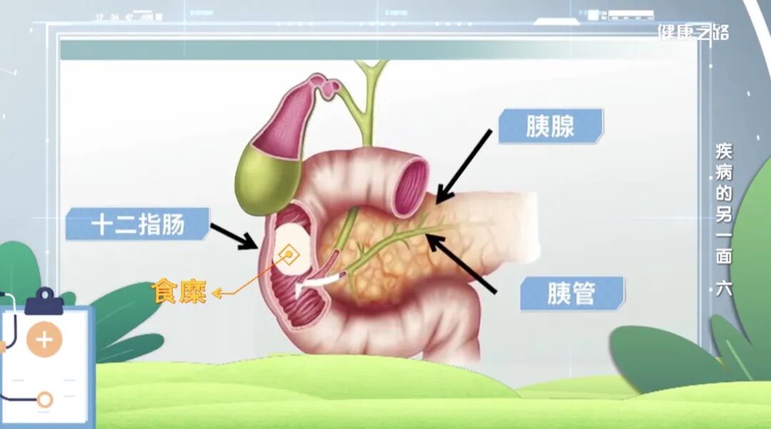 “癌症之王”胰腺癌为何如此凶险？