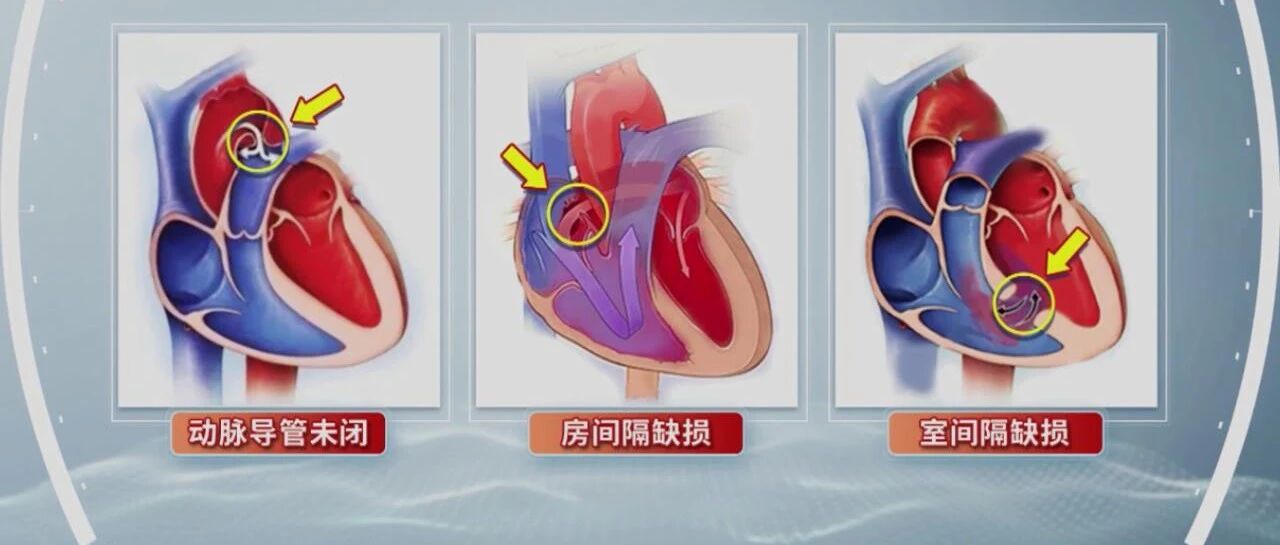 胎儿确诊了先心病该怎么办？来听听专家的建议！丨健康之路