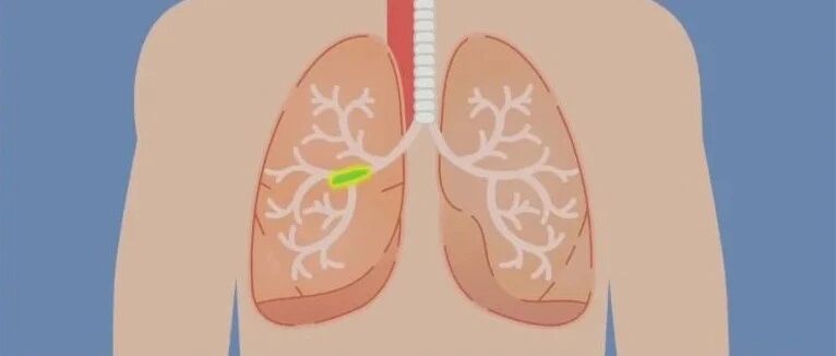 哪些危机正在剥夺你的呼吸权利？呼吸科专家为你解答 | 健康之路