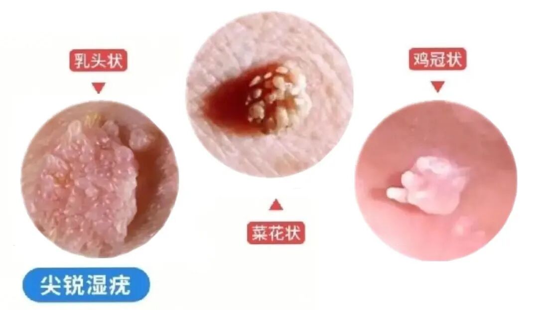 人乳头瘤病毒是什么意思