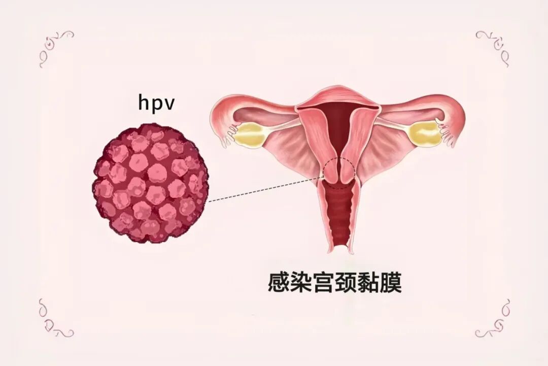 人乳头瘤病毒是什么意思