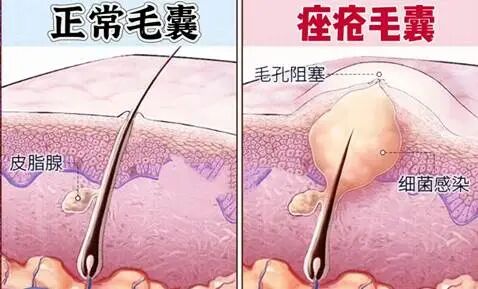 正常毛囊和痤疮毛囊