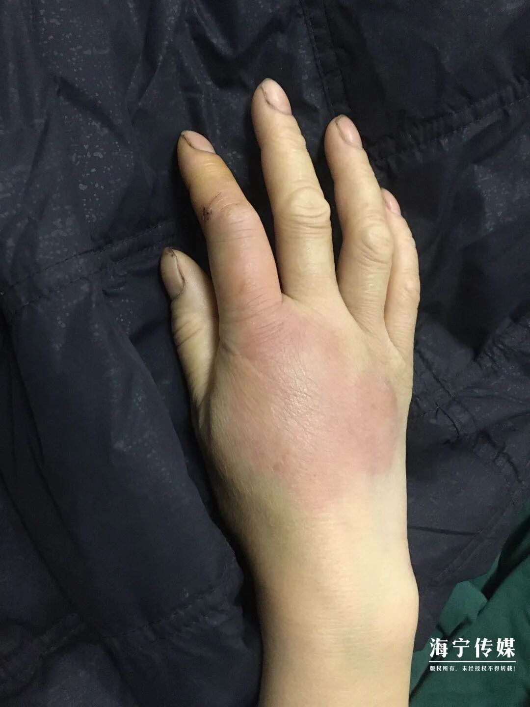 【提醒】可怕毒虫出没,一晚上4人被咬.紧急送医