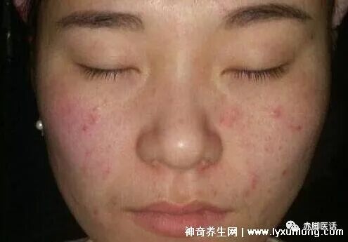 怎么判断是螨虫咬的包_孕妇给螨虫咬涂什么药_螨虫咬人的症状图片