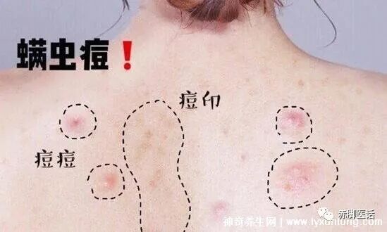 怎么判断是螨虫咬的包_螨虫咬人的症状图片_孕妇给螨虫咬涂什么药