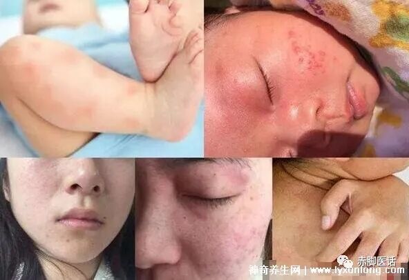 怎么判断是螨虫咬的包_孕妇给螨虫咬涂什么药_螨虫咬人的症状图片
