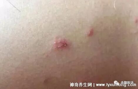 怎么判断是螨虫咬的包 床上螨虫咬的症状图片，像蚊子包在夜间瘙痒难耐(皮肤变差)