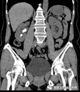 输尿管鞘是什么上尿路结石治疗的又一“神器”---- 头端可弯曲负压输尿管软镜鞘！_https://www.jmylbn.com_新闻资讯_第8张