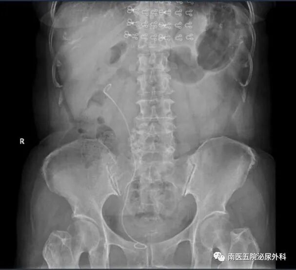 输尿管鞘是什么上尿路结石治疗的又一“神器”---- 头端可弯曲负压输尿管软镜鞘！_https://www.jmylbn.com_新闻资讯_第11张