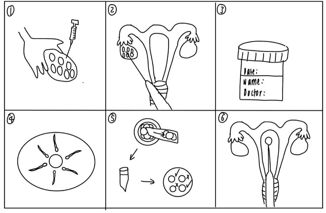 IVF 全流程：取卵→取精→体外受精→胚胎培养→PGT→移植（图片：Dusdn5959 / Wikimedia Commons，CC BY-SA 4.0）