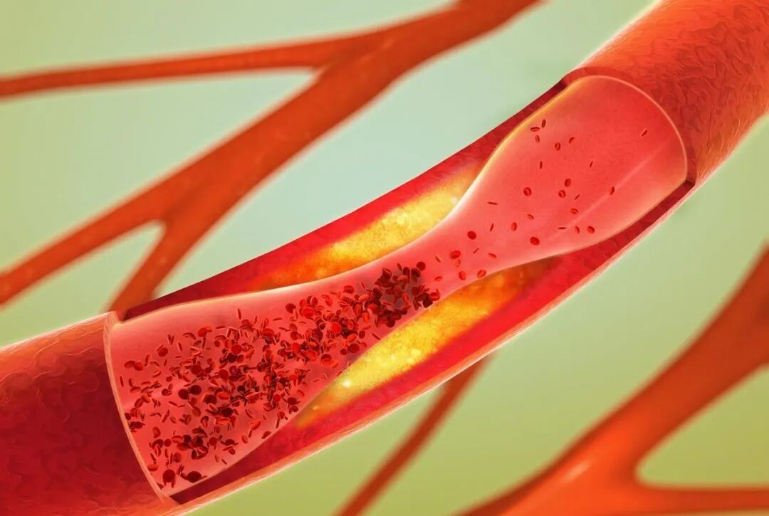 低密度1.4了，5mg的瑞舒伐他汀，能不能继续减半？