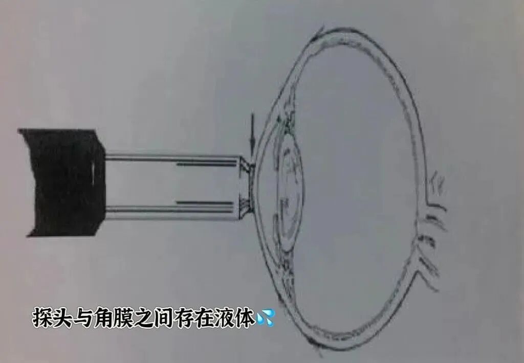 眼科ab超怎么操作了解眼科检查——A型超声_https://www.jmylbn.com_新闻资讯_第12张