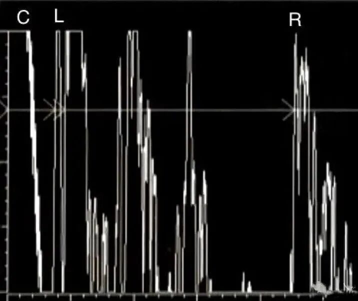 眼科ab超怎么操作了解眼科检查——A型超声_https://www.jmylbn.com_新闻资讯_第4张