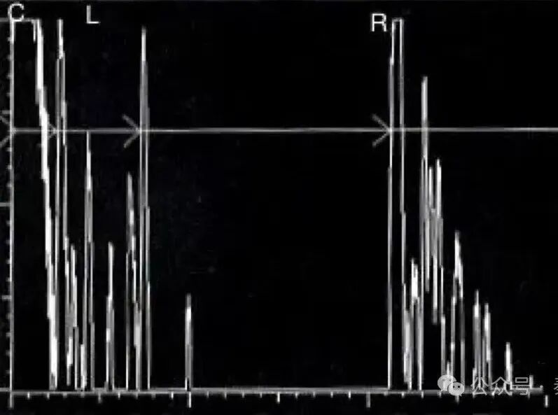眼科ab超怎么操作了解眼科检查——A型超声_https://www.jmylbn.com_新闻资讯_第10张