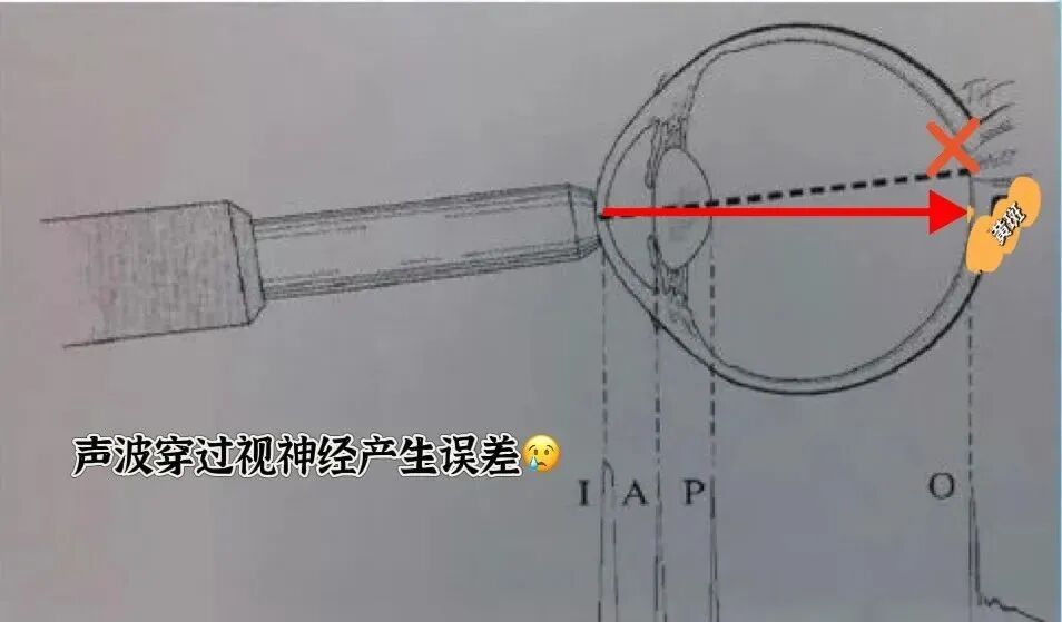 眼科ab超怎么操作了解眼科检查——A型超声_https://www.jmylbn.com_新闻资讯_第13张