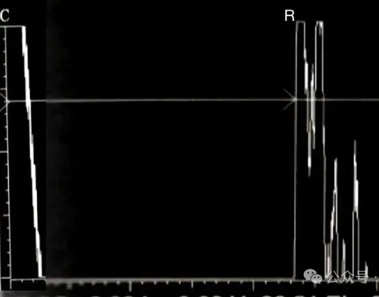 眼科ab超怎么操作了解眼科检查——A型超声_https://www.jmylbn.com_新闻资讯_第8张