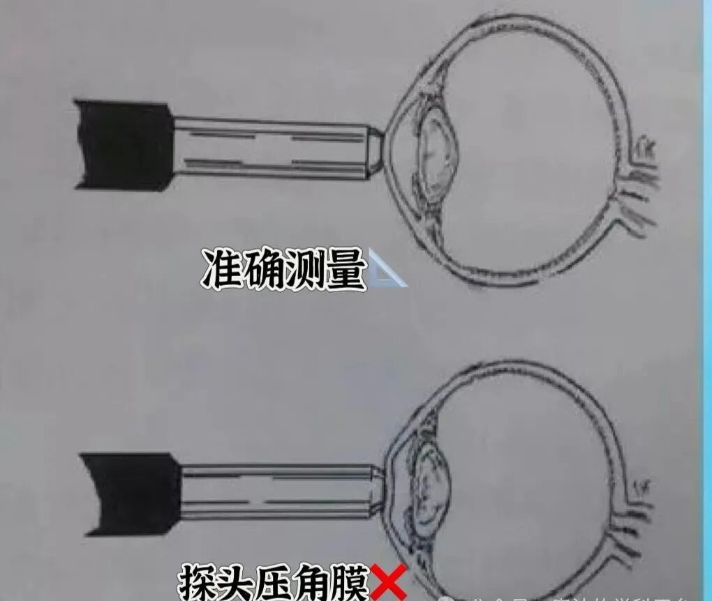 眼科ab超怎么操作了解眼科检查——A型超声_https://www.jmylbn.com_新闻资讯_第11张