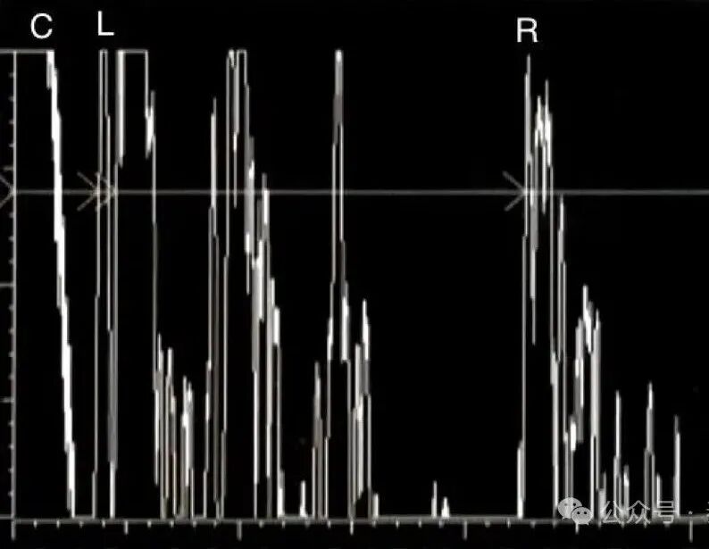 眼科ab超怎么操作了解眼科检查——A型超声_https://www.jmylbn.com_新闻资讯_第9张