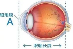 眼科a超单数据怎么看孩子近视的秘密代码，都在一张图中_https://www.jmylbn.com_新闻资讯_第7张