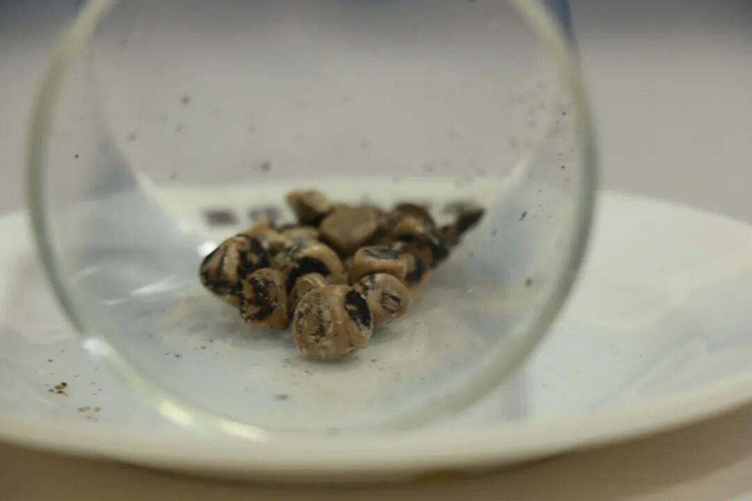 不再被输尿管结石困扰，排石方法立马了解！