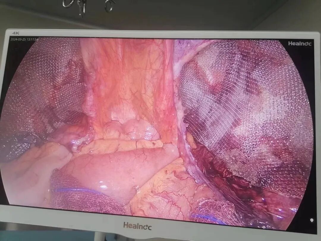 疝气补片怎么固定疝气“补丁” ｜ 腹腔镜下腹股沟疝修补术（TAPP）_https://www.jmylbn.com_新闻资讯_第4张